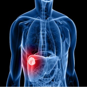 Care sunt principalele simptome ale cirozei hepatice? - Analize 